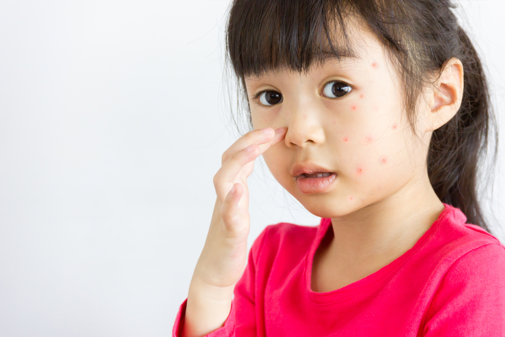 Alergi Menurun dari Orangtua ke Anaknya, Mitos atau Fakta?